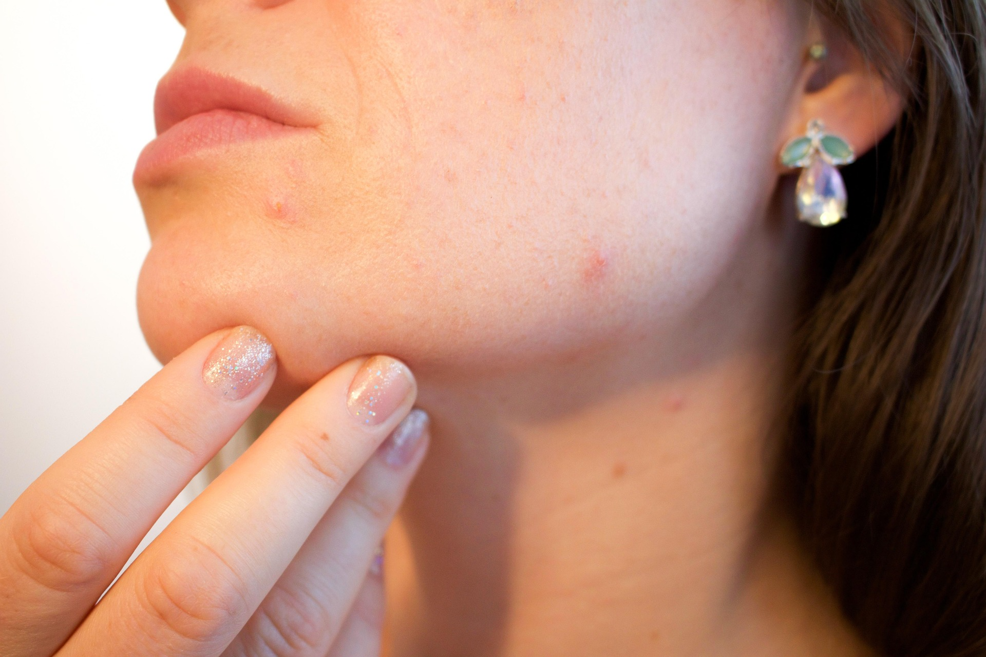 LaDonna Kosmetik Rottenburg - Omega 3 bei unreiner & sensibler Haut